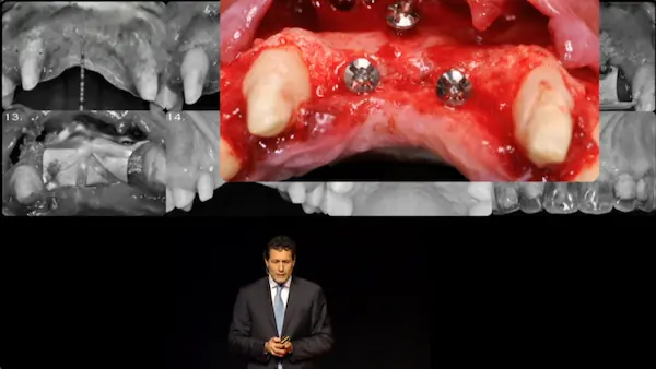 Giorgio Tabanella lecturing about bone graft