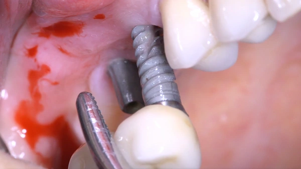 Implant-removal