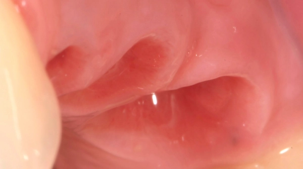 mucosa scalloping
