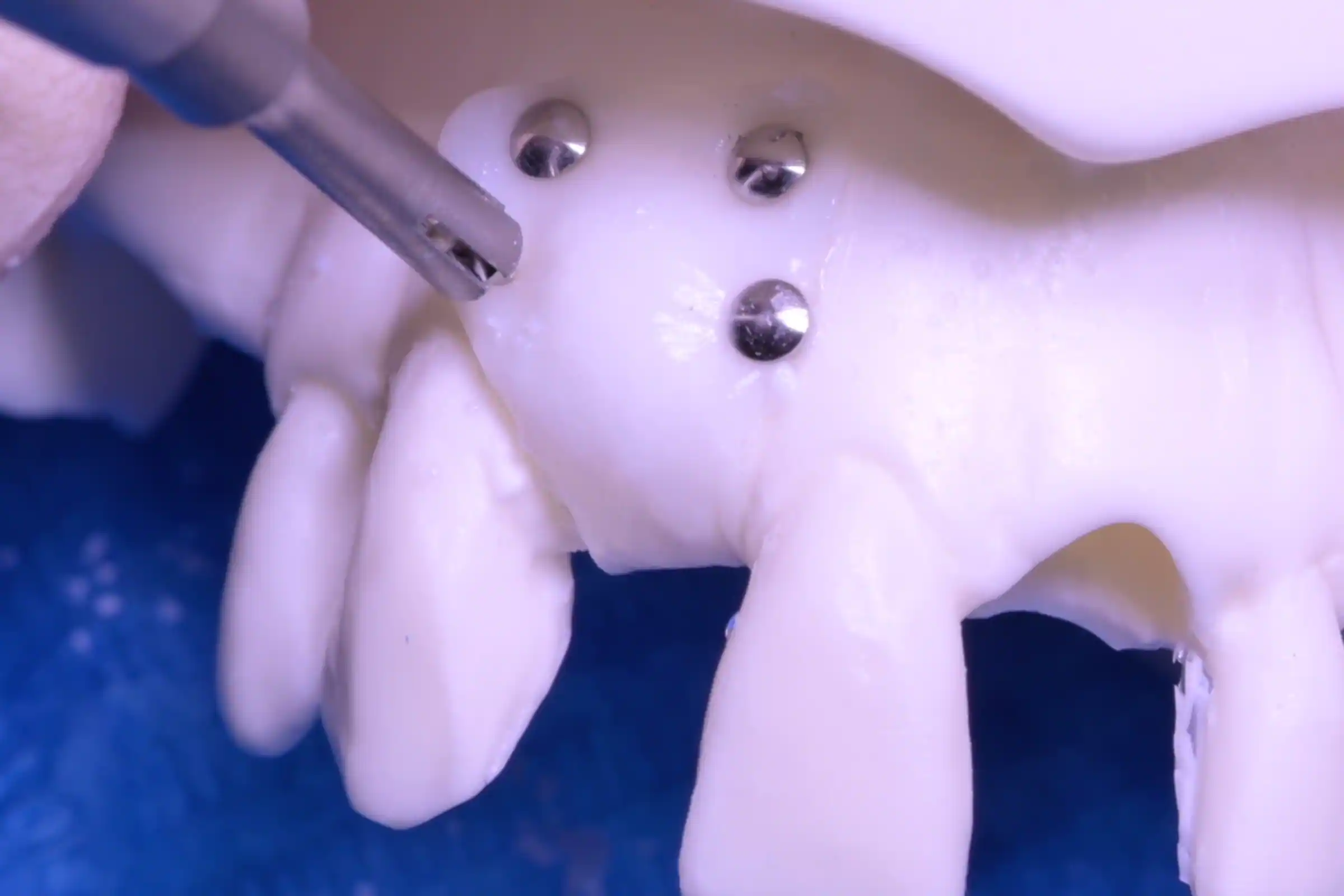 Titanium-pins-fixation